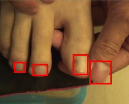 An image of toes and fingers, with red boxes around the nails.